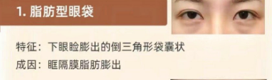 眼袋