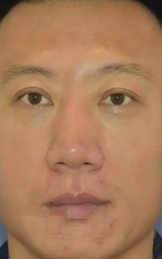 去眼袋手术