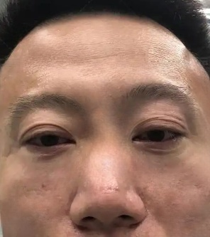 去眼袋手术