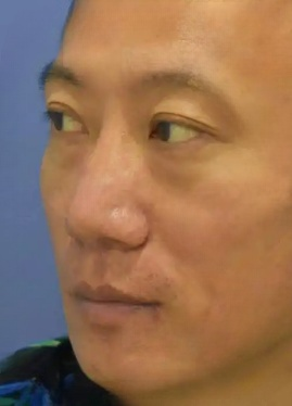 去眼袋手术