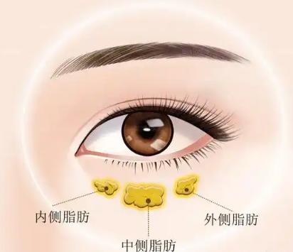 去眼袋手术