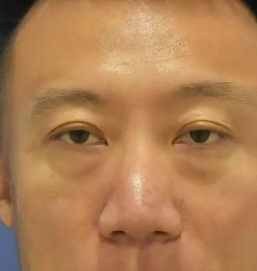 去眼袋手术