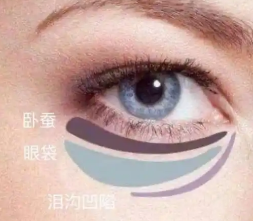 去眼袋手术