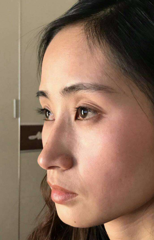 去眼袋手术