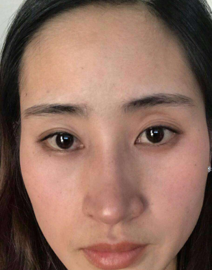 去眼袋手术