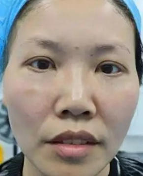 去眼袋手术