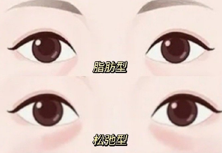去眼袋手术