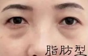 去眼袋手术