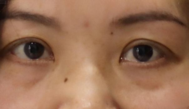 去眼袋手术