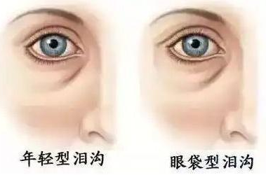 去眼袋手术