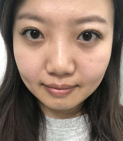 去眼袋手术