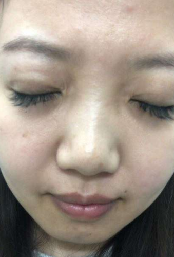 去眼袋手术