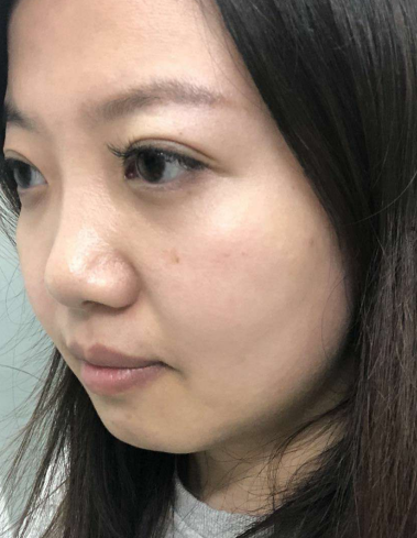 去眼袋手术