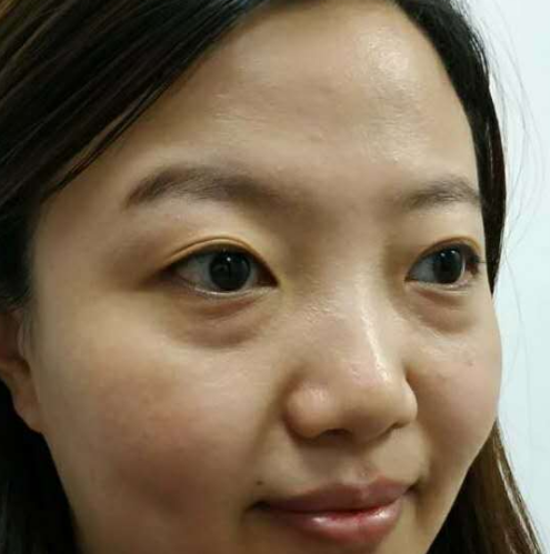 去眼袋手术