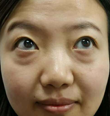 去眼袋手术
