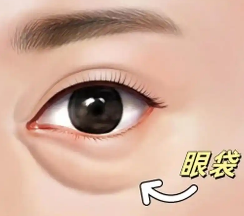 去眼袋手术