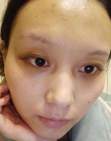 去眼袋手术