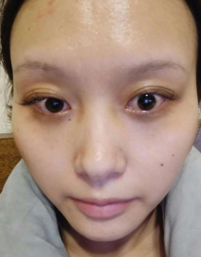 去眼袋手术