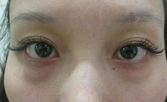 去眼袋手术