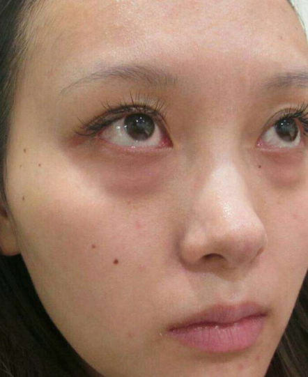 去眼袋手术