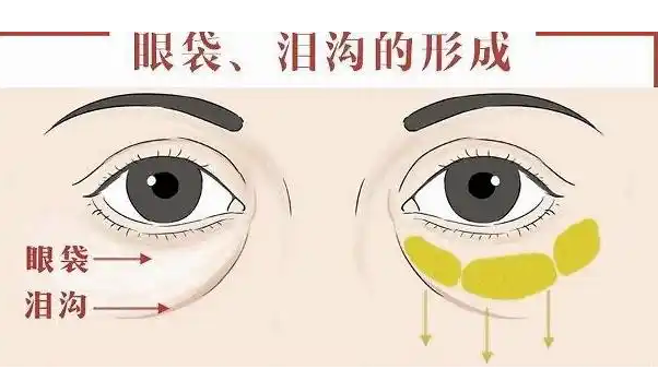 去眼袋手术