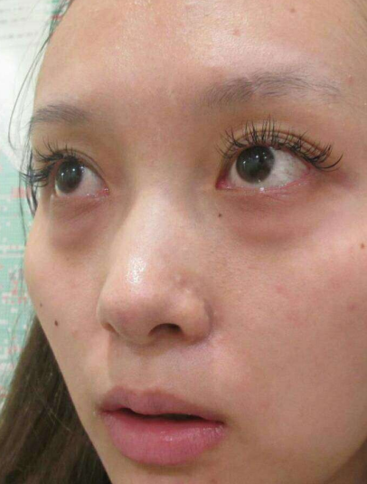去眼袋手术