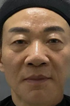 去眼袋手术