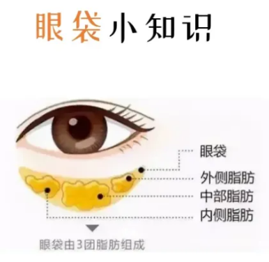 去眼袋手术