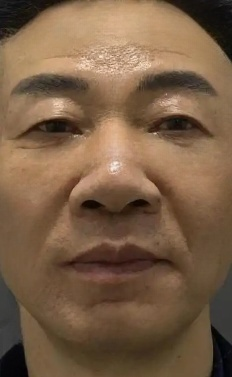 去眼袋手术