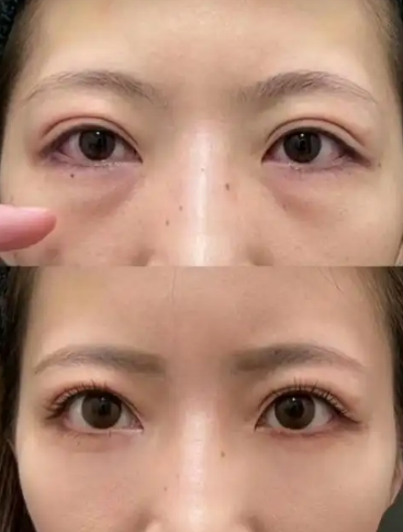 去眼袋手术