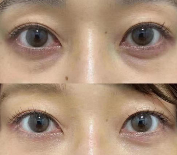 去眼袋手术