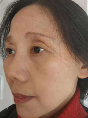 去眼袋手术
