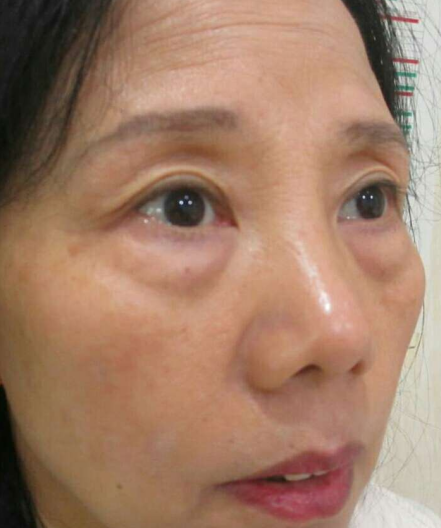 去眼袋手术
