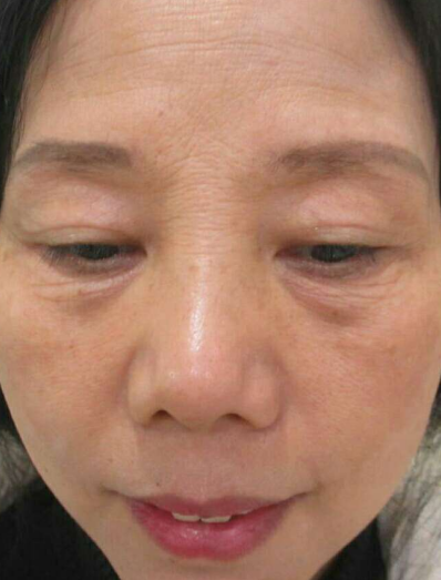 去眼袋手术