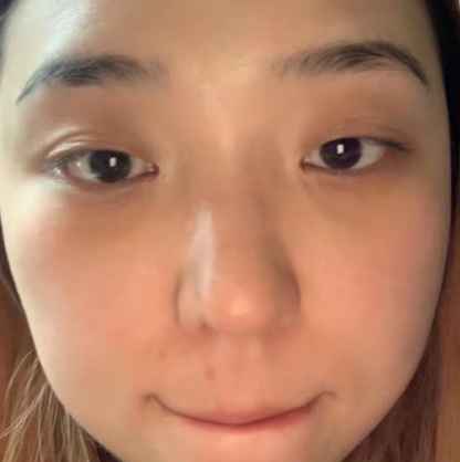 去眼袋手术