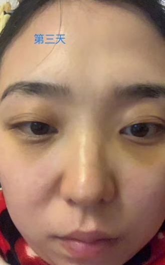 去眼袋手术