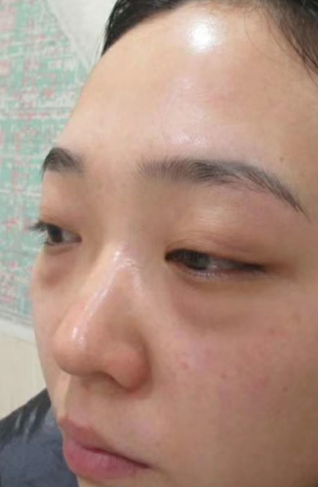 去眼袋手术
