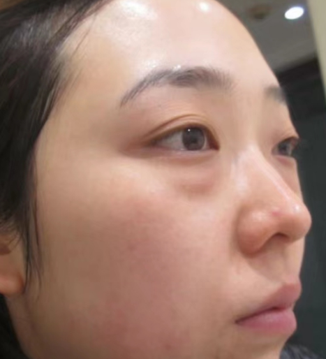 去眼袋手术
