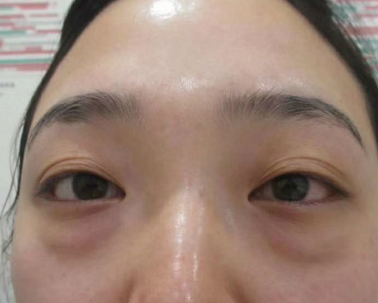 去眼袋手术
