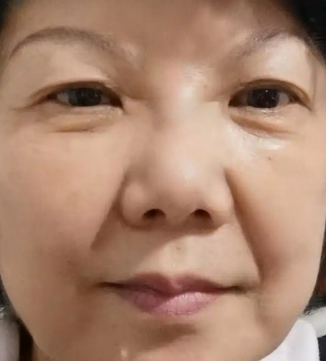 去眼袋手术