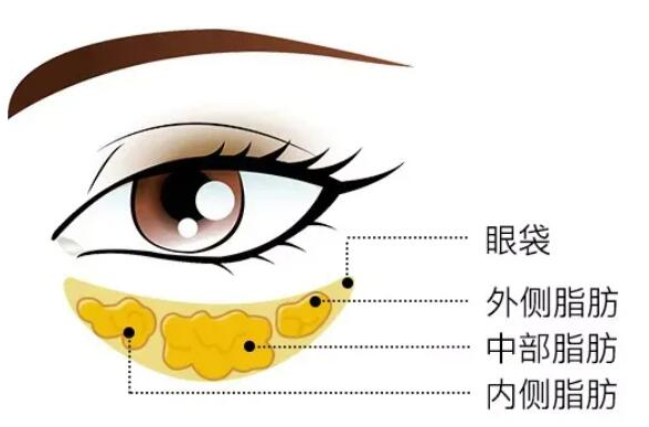 去眼袋手术