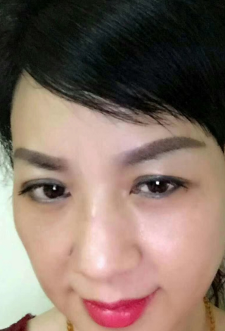 去眼袋手术