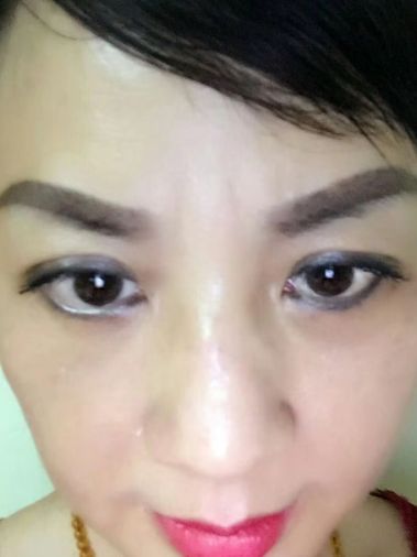 去眼袋手术