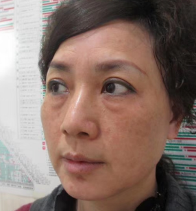 去眼袋手术