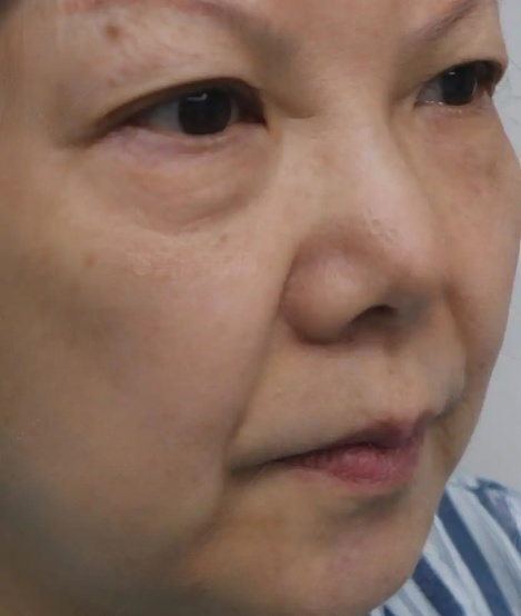 去眼袋手术