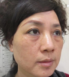 去眼袋手术