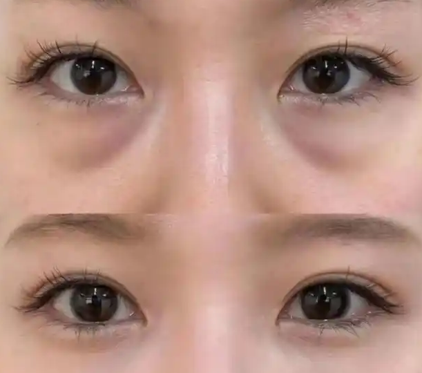 去眼袋手术