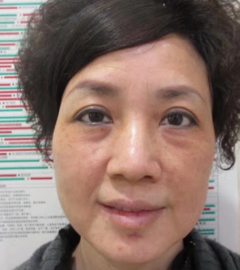 去眼袋手术