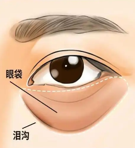 去眼袋手术