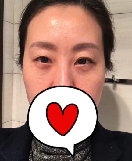 去眼袋手术
